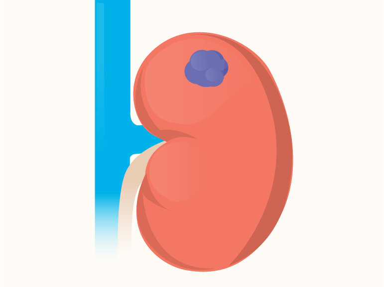 Kidney Cancer: The Silent Disease