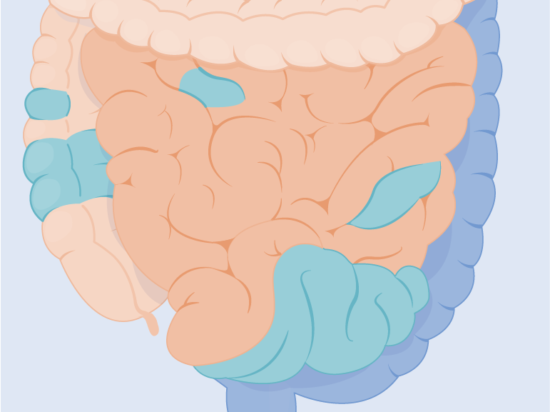 Inflammatory Bowel Disease