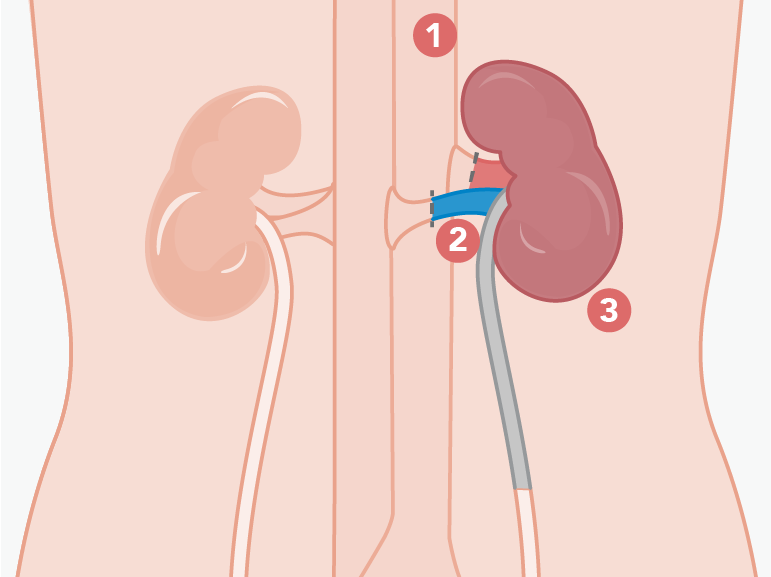 Kidney Transplant