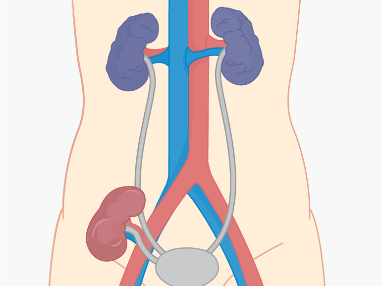 Kidney Transplant