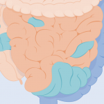 Inflammatory Bowel Disease