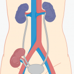 Kidney Transplant